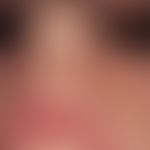 Tuberous sclerosis: Characteristic skin finding in tuberous sclerosis with differently sized, com...