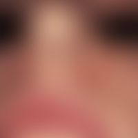 Tuberous sclerosis: Characteristic skin finding in tuberous sclerosis with differently sized, com...