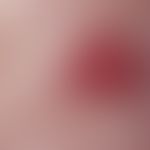 Tuberous sclerosis, reflected light microscopy: In the centrofacially localized "Adenoma sebaceum...