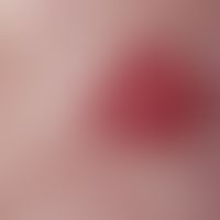Tuberous sclerosis, reflected light microscopy: In the centrofacially localized "Adenoma sebaceum...