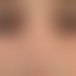 Tuberous sclerosis. brownish-red angiofibroma (so-called adenoma sebaceum) paranasal on both side...