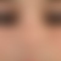 Tuberous sclerosis. brownish-red angiofibroma (so-called adenoma sebaceum) paranasal on both side...
