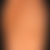 Bourneville-Pringle Phacomatosis, splashlike white spots on the skin, so called ash leave macules...