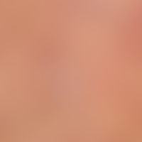 Tungiasis: Detail enlargement of the previous overview. densely standing, 1-5 mm large, partly ro...