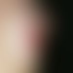 ulcerof the skin. ulcer in calcinosis cutis in progressive systemic scleroderma. 64-year-old fema...