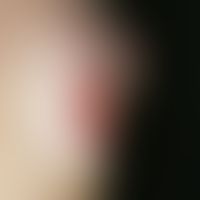 Ulkus der Haut. Ulcus bei Calcinosis cutis bei progressiver systemischer Sklerodermie. 64 Jahre a...