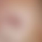 Ulcer of the skin: ulcerated basal cell carcinoma. 61-year-old patient with rapidly progressive u...