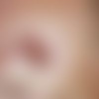 Ulkus der Haut: ulzeriertes Basalzellkarzinom. 61 Jahre alter Patient mit schnell progredienter U...