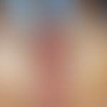 Ulcer of the skin: acute, for 4 weeks existing, despite local therapy rapidly progressive, large,...