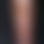 Skin ulcer: bacterial ulcer in immunodeficiency (malignant underlying disease). Yellowish, highly...