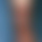 Ulcer of the skin: circularulceration as a complication of a split skin transplant after excision...