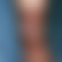 Ulkus der Haut:&nbsp;kreisrunde Ulzeration als Komplikation einer Spalthauttransplantation nach E...