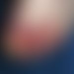 Ulcer of the skin. after accidental scalding with boiling water through an opening hot-water bott...