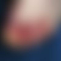Ulcer of the skin. after accidental scalding with boiling water through an opening hot-water bott...