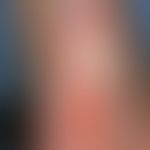 Ulcus cruris arteriosum. Scharf begrenztes, schmerzhaftes, die Sehne erfassendes Ulkus auf dem Fu...