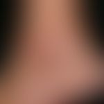 Ulcus cruris arteriosum: chronisches, langsam progredientes, schmerzhaftes, im Bereich des linken...