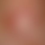 Ulcus cruris arteriosum:&nbsp;Detailvergrößerung: Chronisches, langsam progredientes, schmerzhaft...