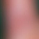 Ulcus cruris venosum. deep, punched out ulcer on the lower leg in CVI. the edges are macerated wh...