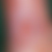 Ulcus cruris venosum. deep, punched out ulcer on the lower leg in CVI. the edges are macerated wh...