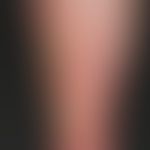 Ulcus cruris venosum. ecthyma-like, infected (Pseudomonas aeroginosa) ulcers with yellowish-green...