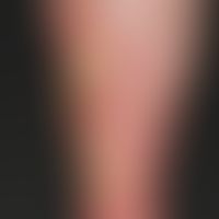 Ulcus cruris venosum. ecthyma-like, infected (Pseudomonas aeroginosa) ulcers with yellowish-green...