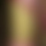 Ulcus cruris venosum. infected (Pseudomonas aeroginosa), with yellowish-greenish coatings overlai...