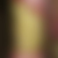 Ulcus cruris venosum. infected (Pseudomonas aeroginosa), with yellowish-greenish coatings overlai...