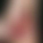 Ulcus cruris venosum. solitary, chronically stationary, retroangulary localized (typical CVI posi...