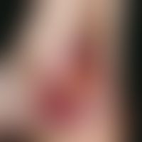 Ulcus cruris venosum. solitary, chronically stationary, retroangulary localized (typical CVI posi...
