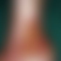 Ulcus cruris venosum, localised at a typical site (ankle region), large, moderately painful ulcer...