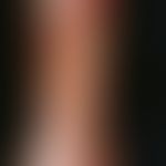 Ulcus cruris venosum. transition of a venous leg ulcer into a gaiter ulcer encompassing the entir...