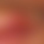 Ulcus molle. painful, greasy, sharply defined ulceration in the area of the upper lip with region...
