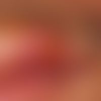 Ulcus molle. painful, greasy, sharply defined ulceration in the area of the upper lip with region...
