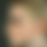 Ulerythema ophryogenes. scarring keratosis follicularis of the face with infestation of the eyebr...