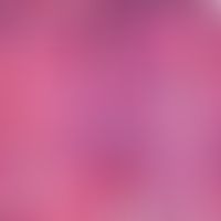Ulerythema ophryogenes. Dilatiertes mit wulstigen orthokeratotischen Hornmassen ausgefülltes Akro...