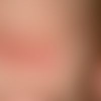 Unna-Politzer-Nackennaevus. Großflächiger, z.T. diffuser N. flammeus mit glatter Oberfläche im Na...