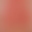 Urticaria factitia: Striated wheals with reflex erythema after mechanical irritation in the area ...