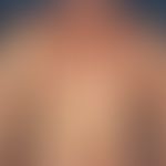 Urticaria pigmentosa: Darkly pigmented maculae and papules, spread over the entire integument, ex...