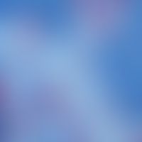 Urticaria pigmentosa, presentation of mast cells by means of antitryptase, strong proliferation o...