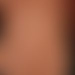 Urticaria pigmentosa: Generalized, macular, livid-red to brownish, partly confluent "exanthem-lik...