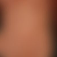 Urticaria pigmentosa:&nbsp;Übersichtsaufnahme: Generalisiertes, makulöses, livid-rotes bis bräunl...