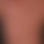 Urticaria pigmentosa, detail enlargement: Macular, livid-red to brownish, partially confluent "ex...