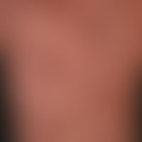Urticaria pigmentosa, detail enlargement: Macular, livid-red to brownish, partially confluent "ex...