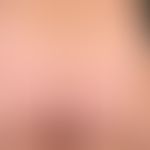 Urticaria pigmentosa. general view: Differently large, disseminated, flat, oval or round, exanthe...