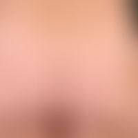 Urticaria pigmentosa. general view: Differently large, disseminated, flat, oval or round, exanthe...