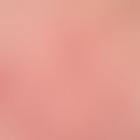 Urticaria pigmentosa:Enlargement of details: Spots of different size, disseminated, flat, oval or...