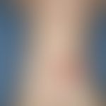 Urticaria pigmentosa:multiple, chronically stationary, known for 1 year, no longer increasing for...