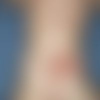 Urticaria pigmentosa:multiple, chronically stationary, known for 1 year, no longer increasing for...