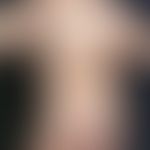 Urticaria pigmentosa. multiple, chronically stationary, 1.0-10.0 cm in size, generalized, yellow-...