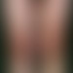 Urticaria pigmentosa. shown here is an overview of the extremities. multiple, chronically station...